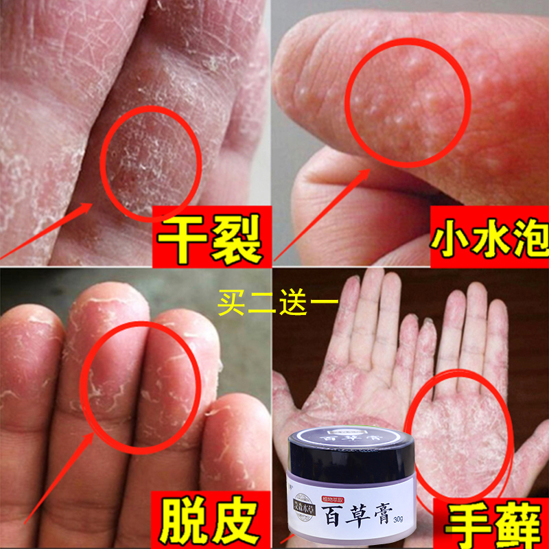 手癣膏手足癣湿疹止痒真菌感染治疗汗脱皮干裂起小水泡藓药膏手气