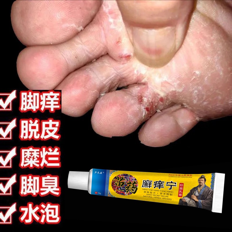 苗家药膏脚气药根治止痒真菌感染水泡去根神器脱皮杀菌专用脚癣痒