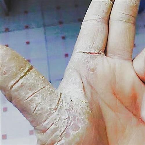 顽固鹅掌风】角质化手癣手掌裂口脱皮发硬干裂手痒掉皮疼真菌感染
