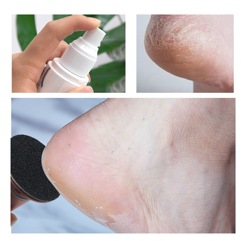 推荐脚底软化剂喷雾足部去死皮刮角质搓老茧修脚后跟使用神器80ml