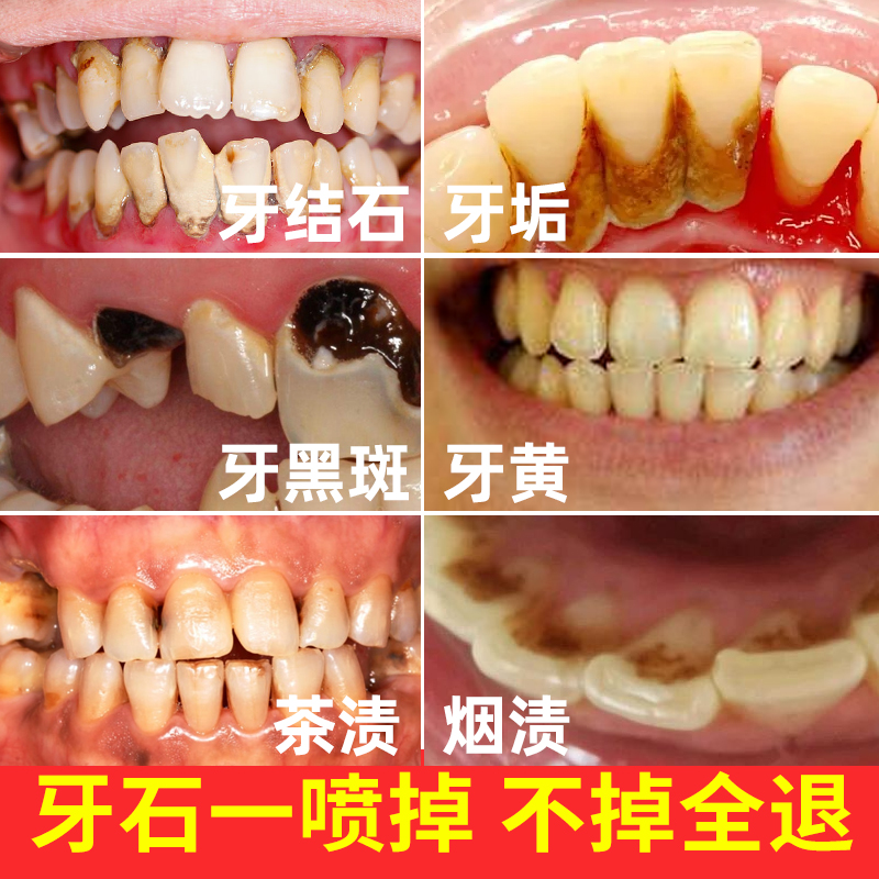 牙结石去除器溶解牙石专用漱口水速效洗牙齿污垢牙垢黄牙清除神器