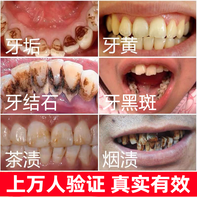 去牙结石专用益生菌牙膏牙齿美白去黄去口臭溶解牙石速效洗白正品