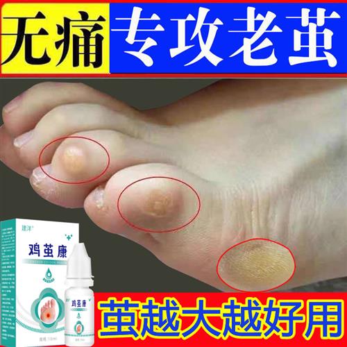 速发去角质抑菌涂g剂去茧护肤抗菌老茧手上脚底死皮硬皮非软化剂