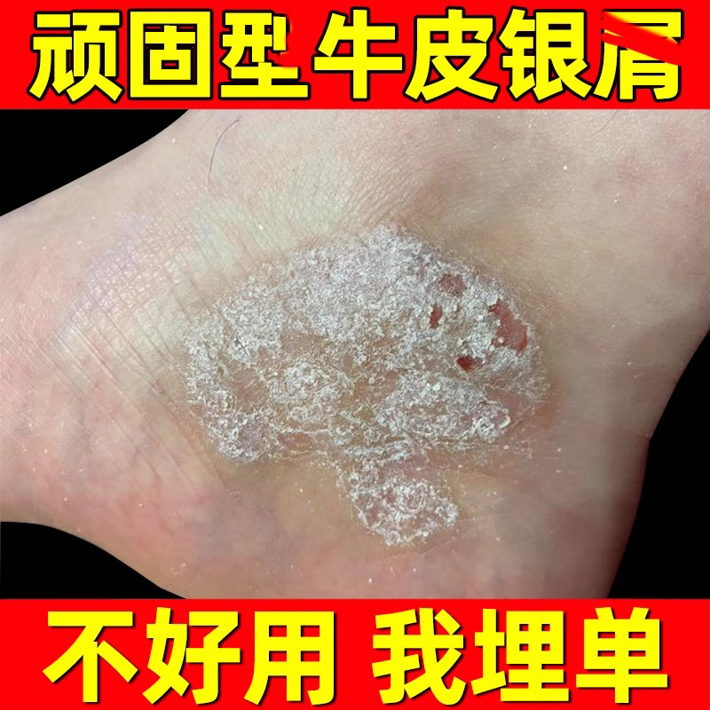 脚癣药膏真菌感染脚藓脚裂皮肤病脚干裂脱皮脚后跟真菌银屑病药膏